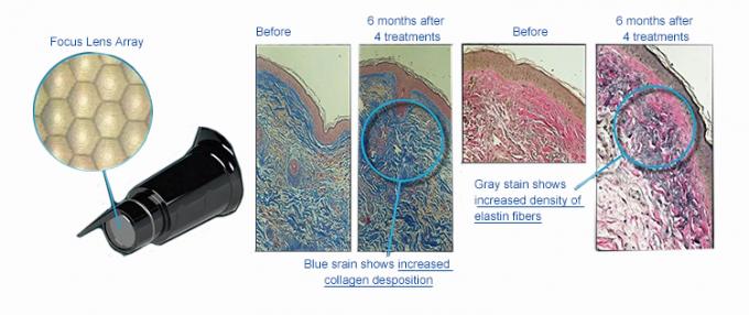 1064nm Picosecond Laser Maschine PICO Einfache Bedienung Pico Pulse Maschine 5